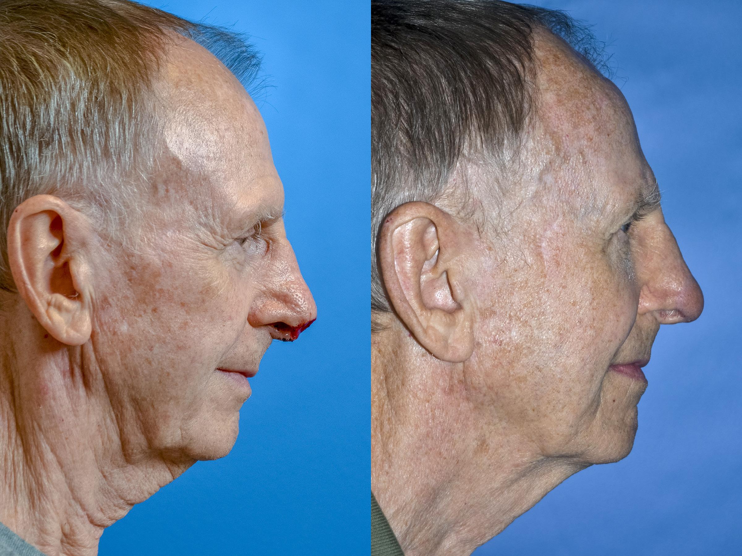 Mohs Surgery And Skin Cancer Photos Melbourne FL Patient 58393